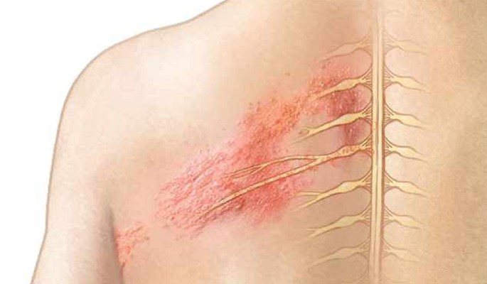 Đau dây thần kinh sau zona - Hình ảnh minh họa